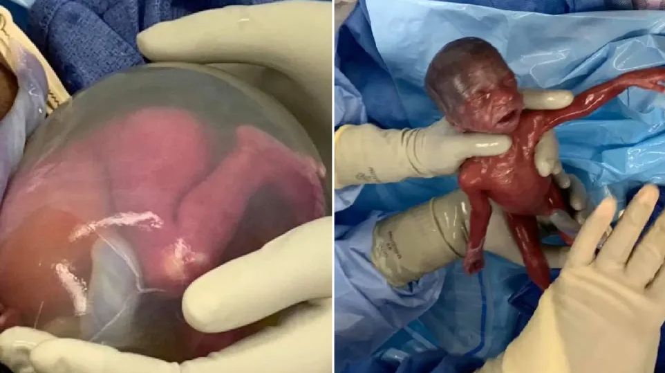 Premature Baby Girls Born at 22 Weeks are the 2nd Youngest Ever to Survive. Look at Them Now buff.ly/3eLjHHD