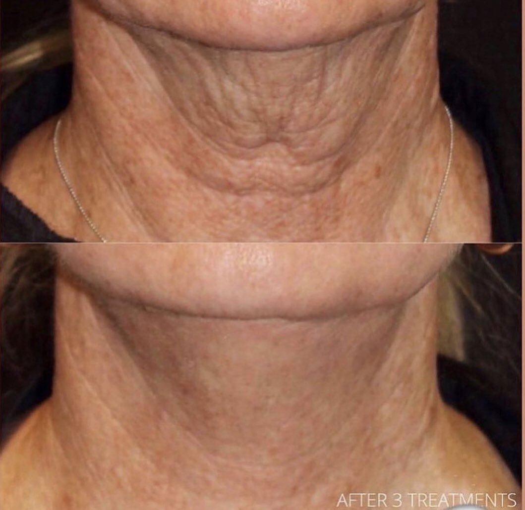 Does your skin laxity on your neck bother you but you’re not ready for surgical intervention? Our Genius RF can help tighten & tone the skin over time! This is the result of 3 sessions performed by our providers; Vanity Clinics.