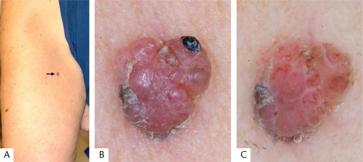 From arppress.org/books/book/64: 'Nodular melanoma' can represent either 1) a primary dermal invasive melanoma without associated in situ melanoma; or 2) a primary invasive melanoma accompanied by in situ melanoma that does not extend beyond the invasive tumor. #DermPath