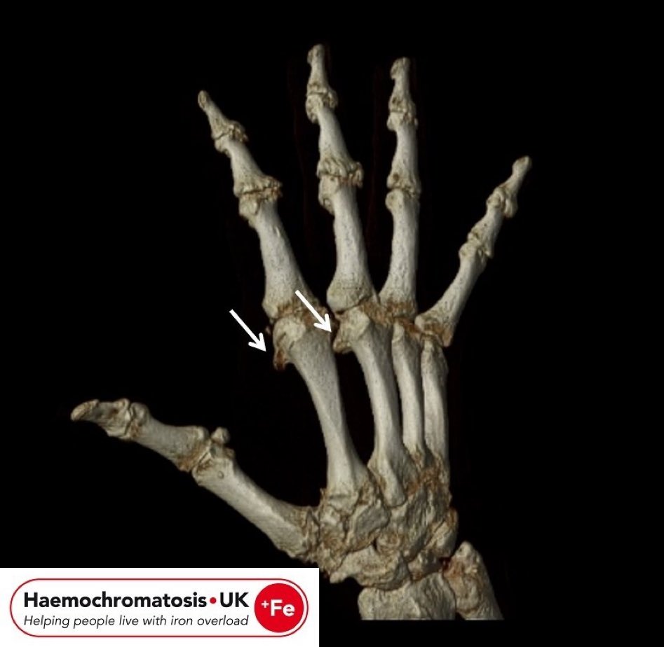 Hooking osteophytes at MCPJs in #Haemochromatosis by @IronOverloadUK