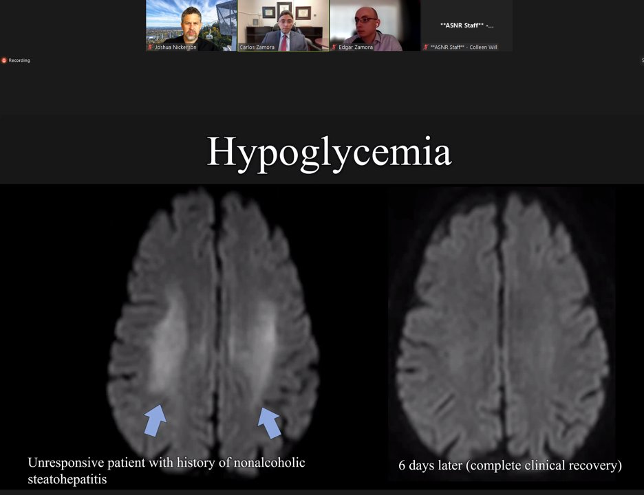 Thanks to Dr. Zamora and Dr. Zamora for presenting today's @TheASNR @ASNRographics webinar- fascinating (but morbid) topics being discussed right now!