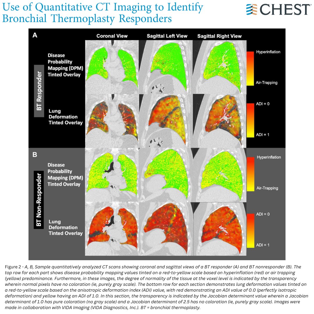Original research results show that preservation of normal lung expansion, a greater magnitude of isotropic expansion, and more were predictors of future bronchial thermoplasty response. Read the results in the April issue: hubs.la/Q02t-8s20 #JournalCHEST #MedEd