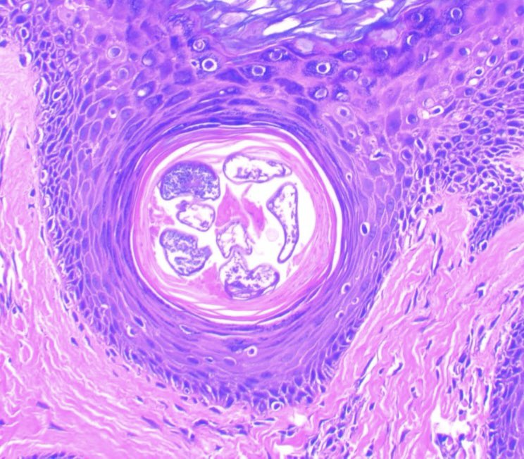 I do not want to scare you guys, 🧟🧟‍♀️but there are more guests in our skin than we can imagine!🤣🤣 Demodex folliculorum #path #medicine #dermpath #pathology #parasites