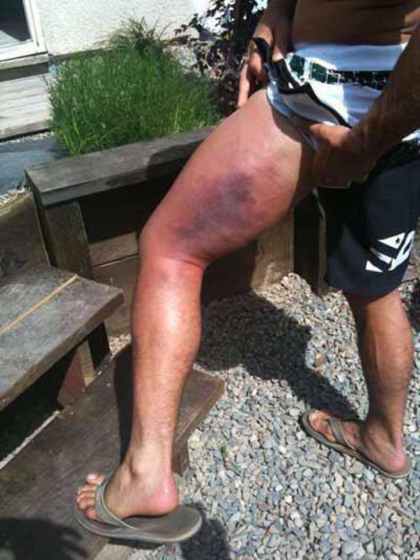 MMAHistoryToday's tweet photo. Apr24.2010

Jose Aldo makes the first defense of his WEC Featherweight title, when he puts on a leg kick clinic against Urijah Faber.

This is what Aldo did to Faber’s leg. https://t.co/g8l9TlszvH