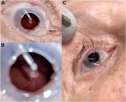 Ophthopedia Update: Hollow Globe after Traumatic Cornea Transplant Dehiscence dlvr.it/T5ysNc #Ophthalmology #ophthotwitter #eyecare