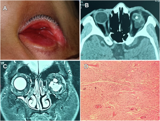 Ophthopedia Update: Congenital Microphthalmos with Optic Nerve Glioma dlvr.it/T5ysNs #Ophthalmology #ophthotwitter #eyecare