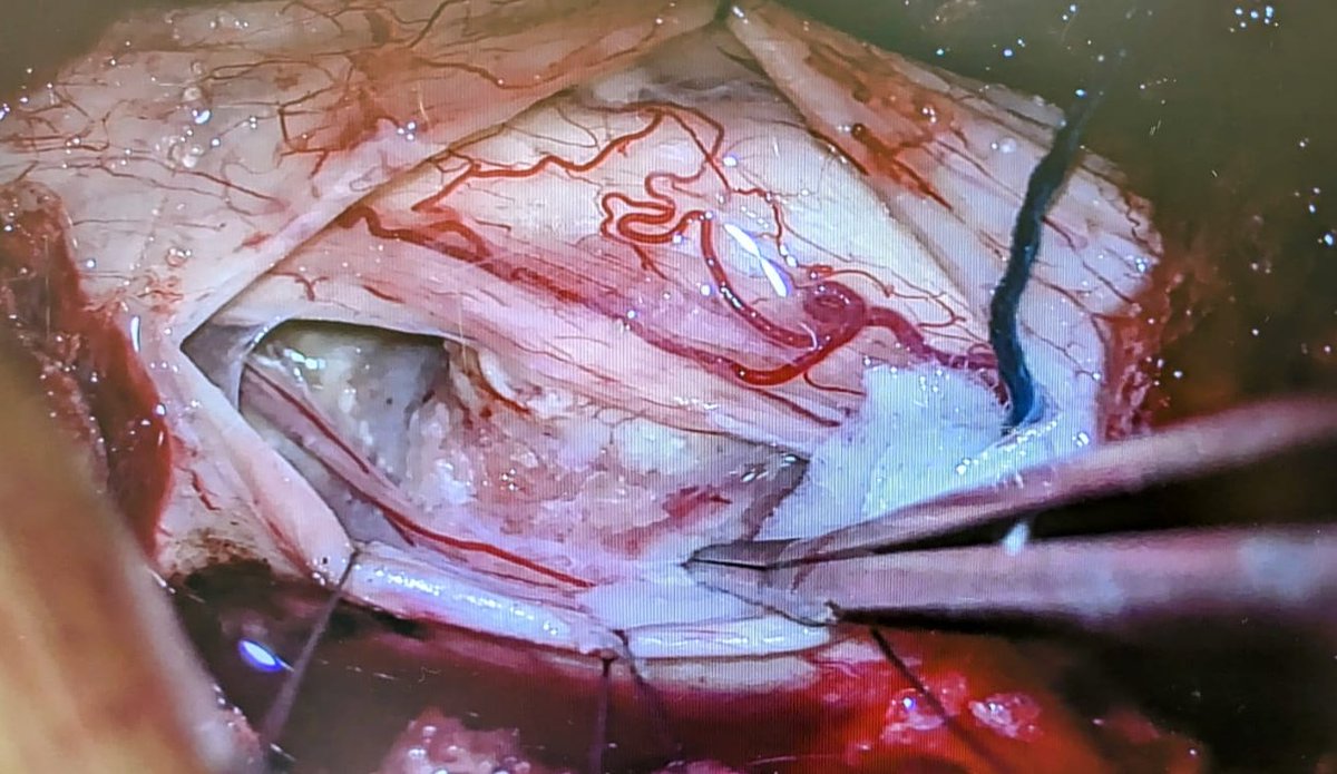 Latest trends make the surgeon to choose between opening the dura or the thoracic cavity. In this calcified giant thoracic herniated disc, a transdural approach was selected.The ipsilateral pedicle was removed to maximize the surgical corridor and minimize cord retraction.#HUMS
