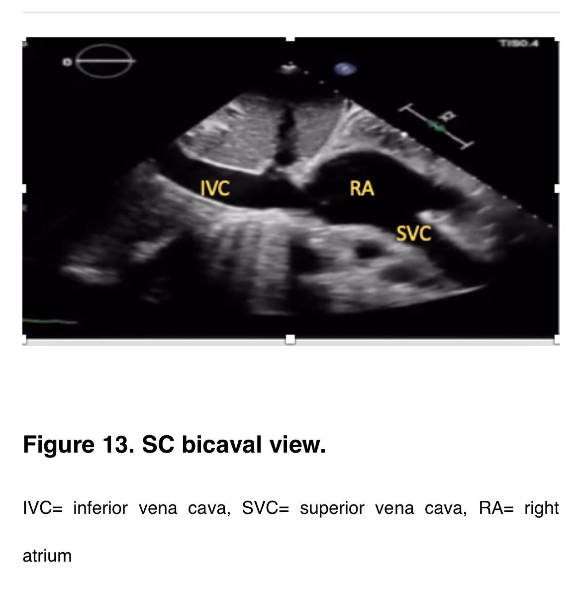 @ASRA_Society @shaskinsMD @HSSAnesthesia @NarouzeMD @townsley_matt @KukrejaPromil @karenboretsky @Duke_Anesthesia @stanfordanes @PennAnesthesia @MayoAnesthesia @RAPMOnline @dr_rajgupta @sites_brian @ICUltrasonica @Wilkinsonjonny @icmteaching #POCUS
🔺 9) Subcostal cardiac 🫀 ultrasound:
#ASRAPOCUS Spotlight series! 
🔴 asra.com/guidelines-art… @ASRA_Society 
Thx 🙏@iceman_ex @LukeFlower1 @easypocus @dr_pradm 🙏