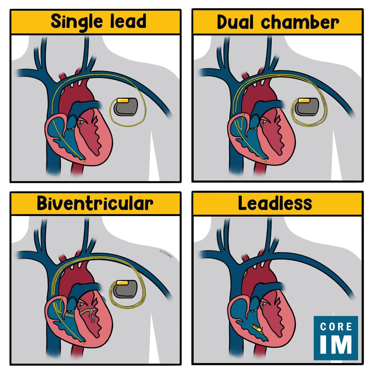 Pacemakers