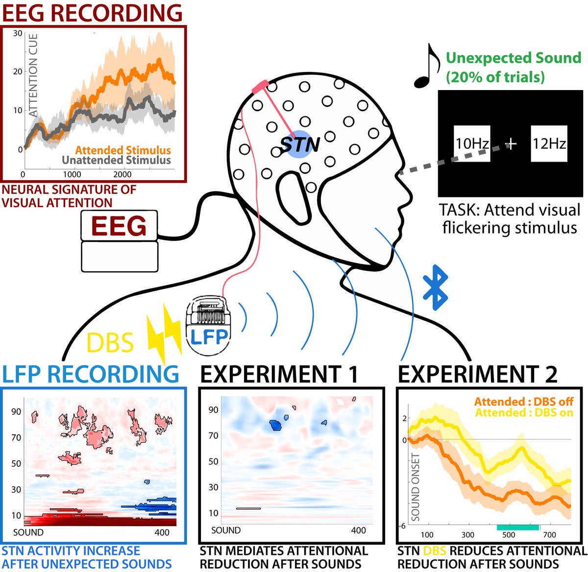 By wirelessly recording signals from deep-brain stimulators in patients with Parkinson's disease in an outpatient setting, Soh et al. show that the STN – known for its role in motor control – also exerts control over attentional processes. tinyurl.com/mvuwy785