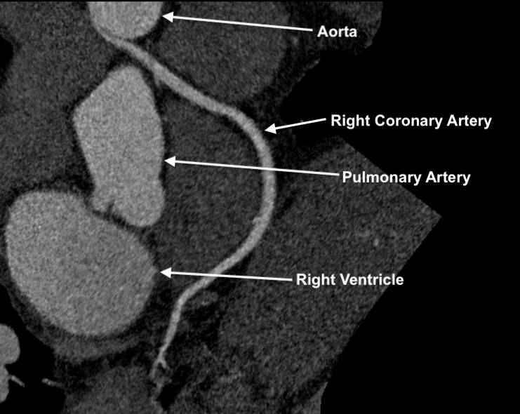 Our team published a case study about a woman with an abnormally positioned coronary artery that was being squeezed during exercise.

Using advanced CT scans and a new technology called CTA-FFR, we determined that the artery could still supply enough blood to her heart without