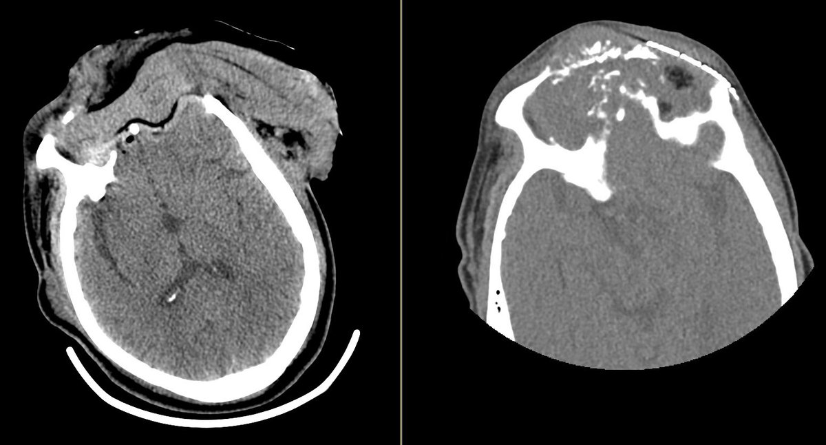 drvijay_agarwal's tweet photo. Full skull base house yesterday (NSU, facial plastics/ENT, flap team) @MonteNeurosg. Transfacial + bicoronal + vascularized ALT flap for previously resected/radiated high grade glioma. Traumatic loss of the left eye (bullet still in orbit), so careful to preserve the right https://t.co/ClRlH0Ytol