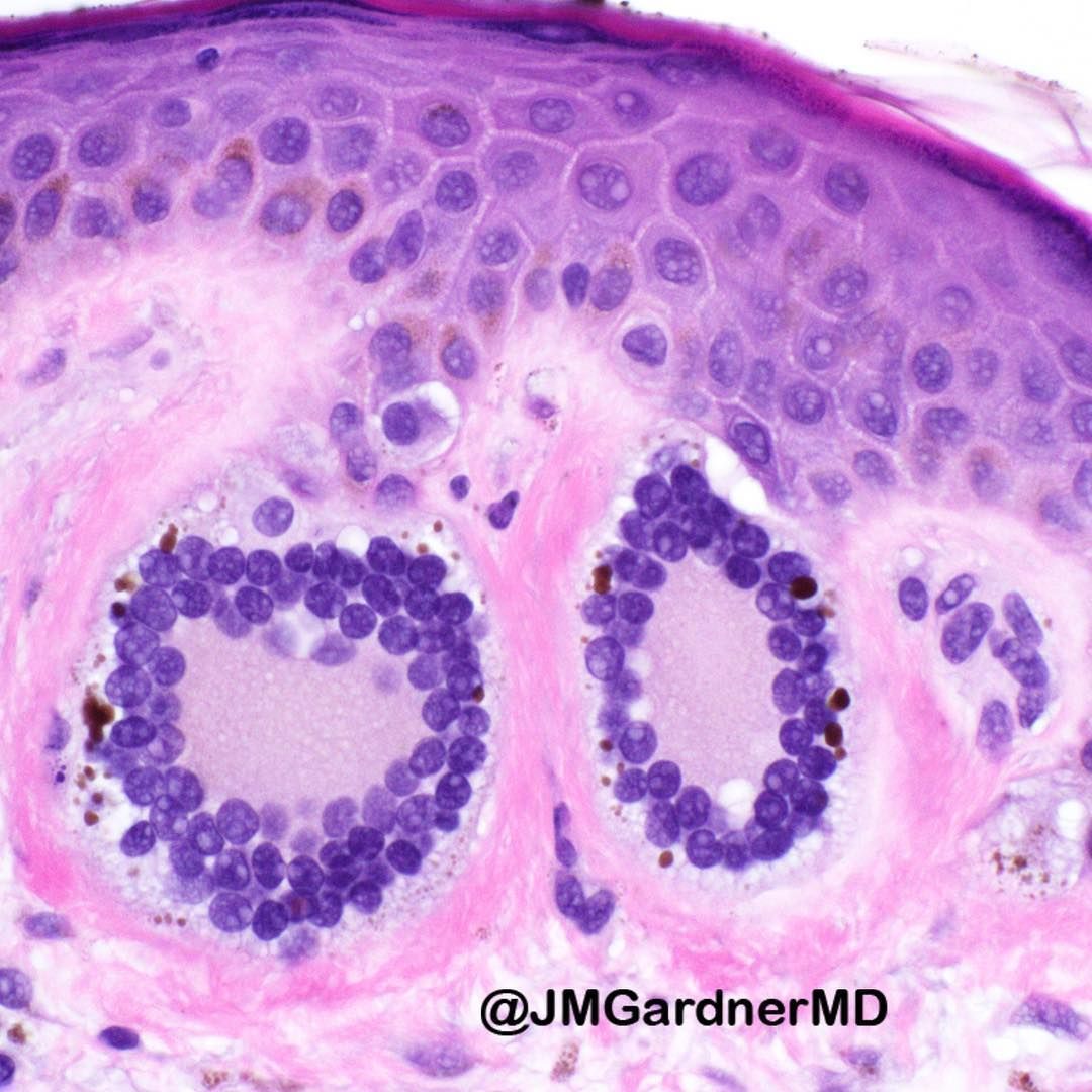 What are these lovely wreath-like cells? And why are they NOT Touton giant cells? Answers here: kikoxp.com/posts/8571. #pathology #pathologists #pathTwitter #dermpath #dermatology #dermatologia #dermtwitter
