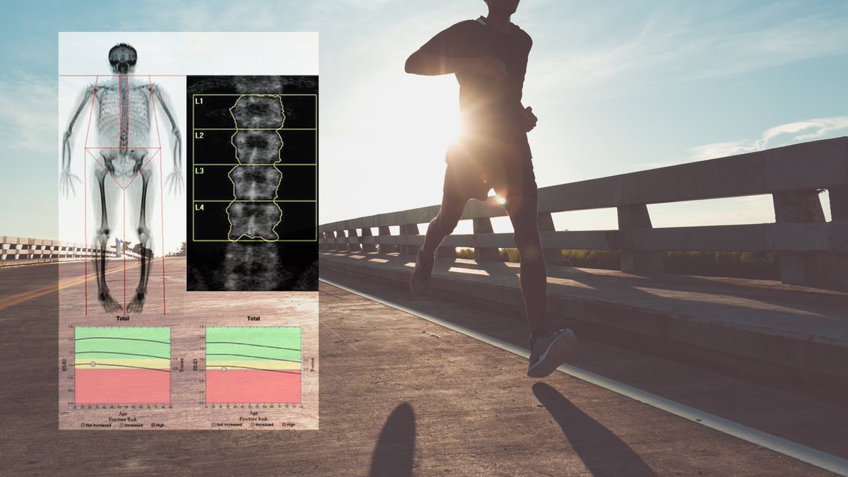 Unexpected discovery: this 32-year-old runner, otherwise healthy, discovered significantly low bone density during a body scan for athletic performance, and is now seeking proactive treatment for Osteoporosis. Stay proactive in your health journey at bodycomp.ca #DEXA