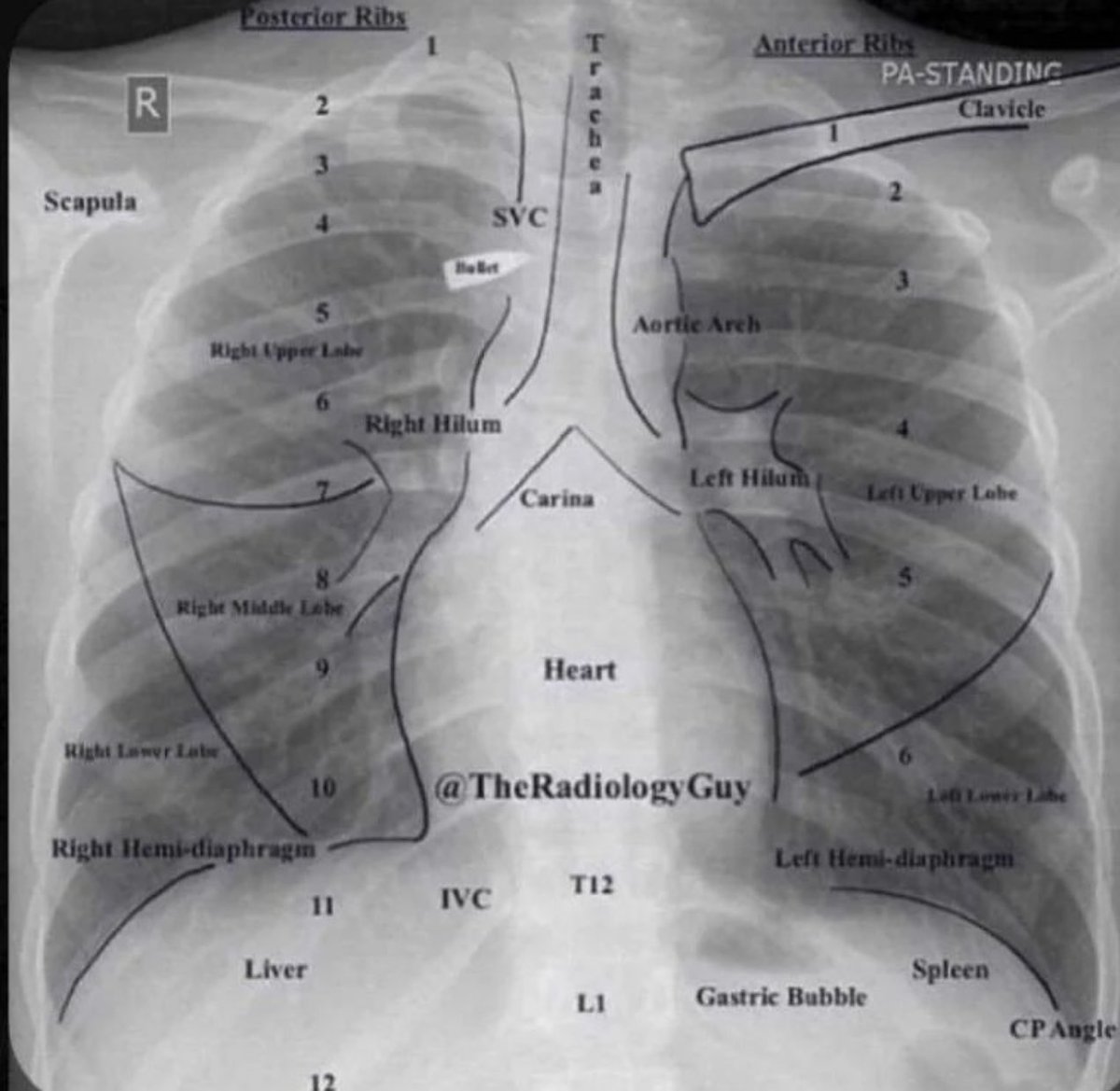 OGdukeneurosurg's tweet photo. Chest Xray the radiology guy https://t.co/LJLzL6pI8J