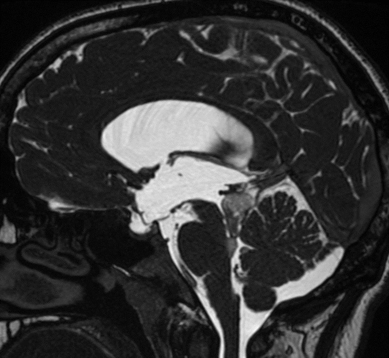 What is the most likely diagnosis in this 25 y/o M presenting w/ headaches?

🔷More images in 🧵 

#Medicine #MedEd #NeuroX #neurosurgery #radres #futureradres #neurology #ENT