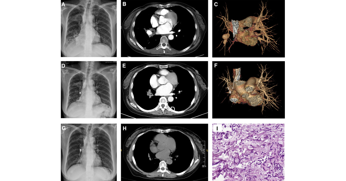 Pulmonary Artery Pseudoaneurysm Caused by Pulmonary Mucormycosis 🔗 bit.ly/3J8nXB2