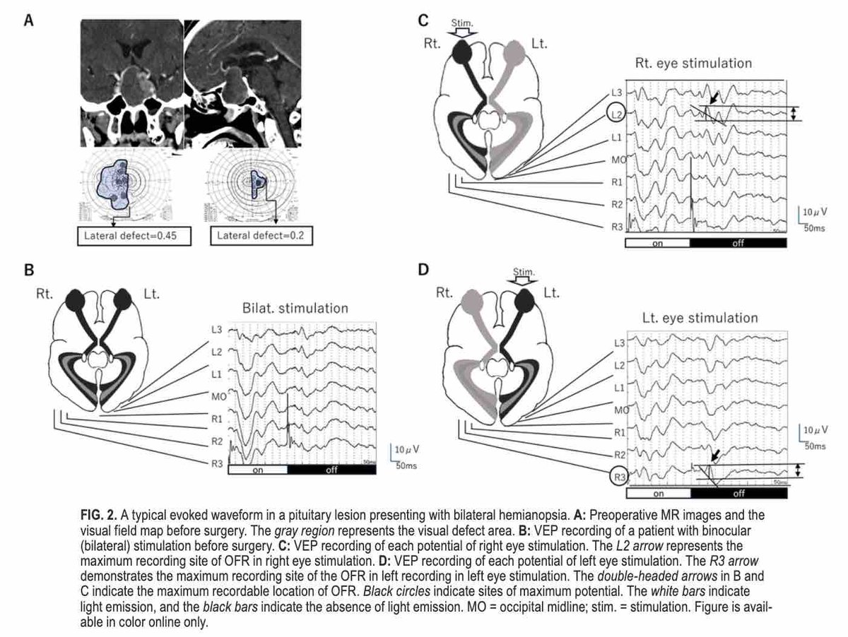 #OnlineFirst: How should visual function monitoring be performed and interpreted in surgery for suprasellar tumors? thejns.org/view/journals/….