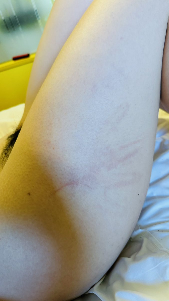 내 엄지손가락은 어디갔지..