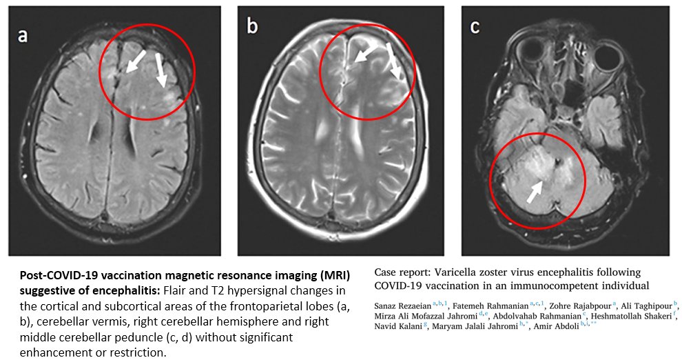 Varicella zoster virus encephalitis after COVID-19 vaccination: cell.com/heliyon/fullte… 'It is important to monitor vaccinated people for potential side effects of COVID-19 vaccination.'