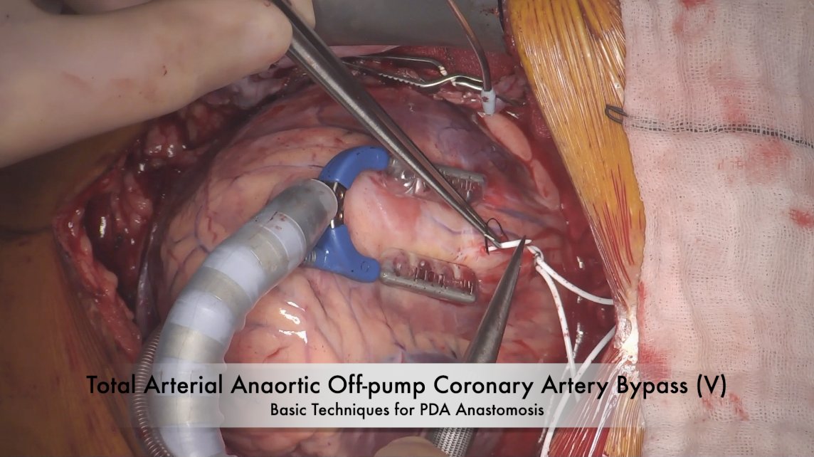 “Deep Dive Into Total Arterial Anaortic Off-Pump Coronary Artery Bypass Grafting: Radial Artery to Posterior Descending Artery Anastomosis” |Tristan Yan’s technique for radial artery to posterior descending artery anastomosis during anaortic off-pump CABG. ow.ly/VwhA50RfbC8