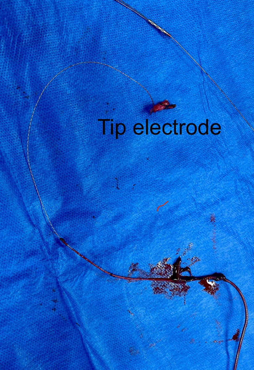 Friday night PSA from neighborhood lead extractor. PLEASE do not implant tined leads in patients under 50 years of age. In fact, please consider never putting in tined leads. See below pic: 7 year old tined MDT atrial lead that was a high sphincter tone extraction. #Epeeps