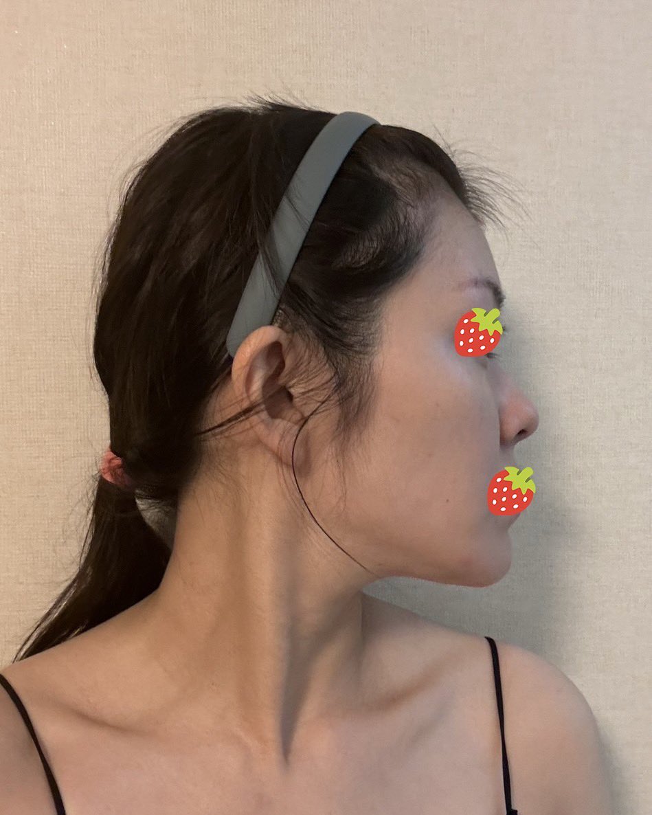 itsumo_dt's tweet photo. 【初鼻フル整形DT４ヶ月】
1.2枚目　before
3.4枚目　after

かなり馴染んできた気がする🫶
整形感はあまり無くって自然に綺麗な形になってきた💓

@bananaps__ 
執刀医　チェ・ウォンチョル先生 https://t.co/3cUoeVdthI