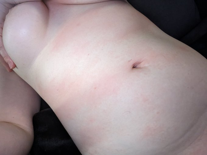 I thought I was just not and itchy from sweating at work and my sports bra, but nope. I wish the pics/camera<a href="/tag/valentinesday"class="tags"><span>#valentinesday</span></a>