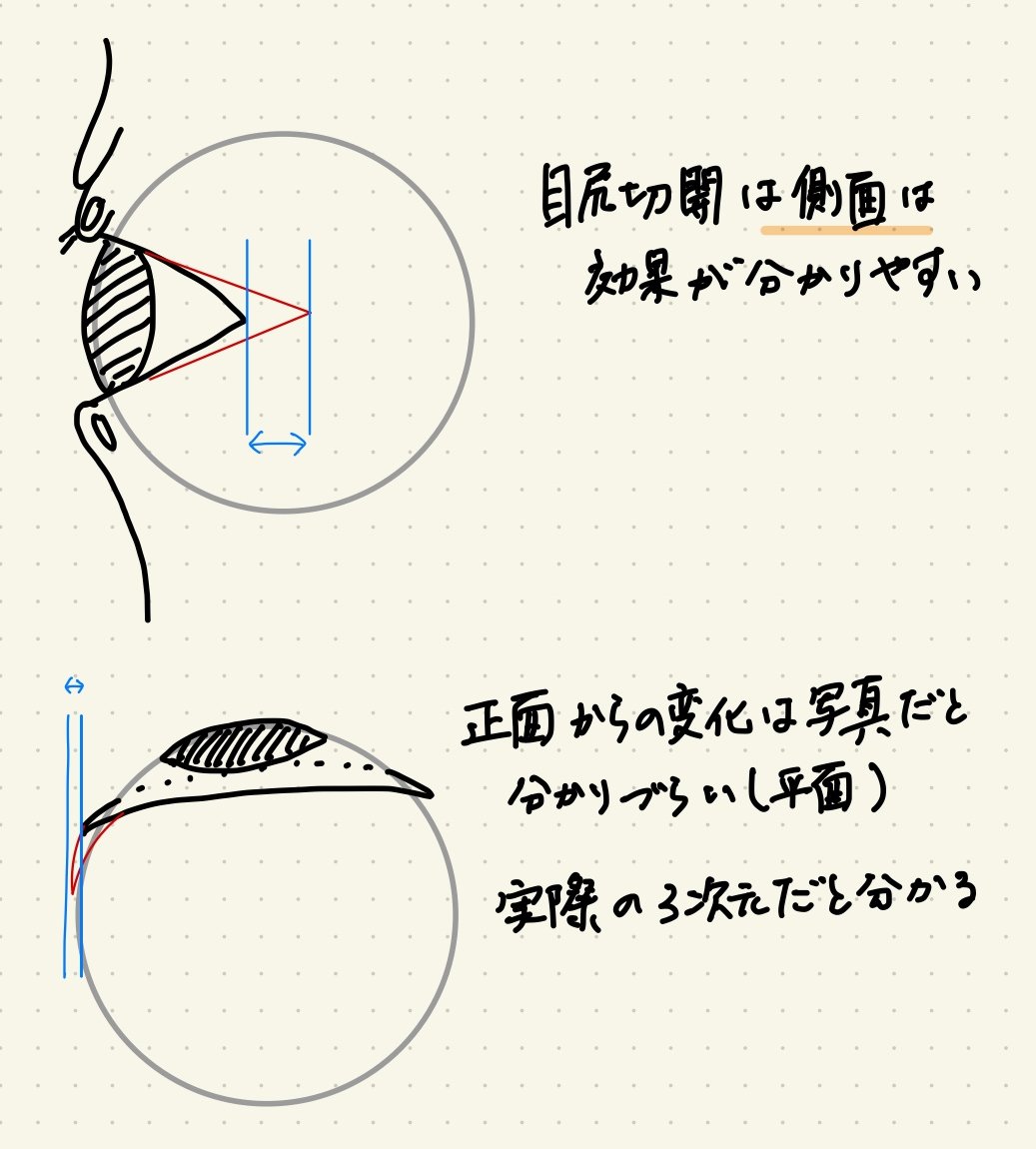 Dr_RayTKD's tweet photo. 【目尻切開とグラマラスの選択法】

「求心顔だから目尻切開したい」
「ツリ目だからタレ目形成したい」
「目尻切開とタレ目併用したほうが長持ちすると聞いた」
とか聞いたり、聞かなかったり。

どう拡大したいのかで、どの術式を選択したらよいのかをまとめました。
目尻切開で横幅広げたいって人に、いつも話している内容もまとめました。眼球は球体なんです、正面からはわかりにくいんです。

皆さんの参考になれば幸いです。