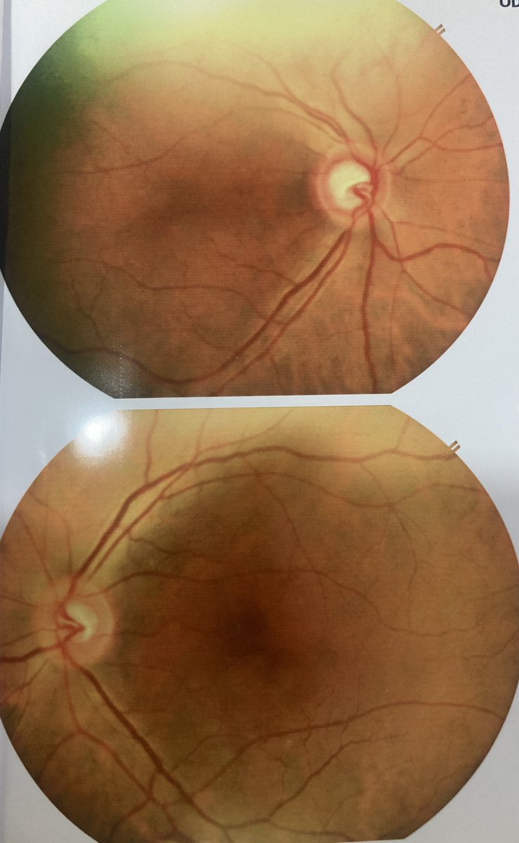 Interesting case:

68 year old lady was referred for glaucoma evaluation. No systemic diseases. No history of glaucoma in family. 

Pupils brisk
BCVA 6/6,N6
SLE unremarkable
Fundus as shown
Periphery normal
IOP 20 mmHg OU
Gonio open angles till ciliary body band with minimal…