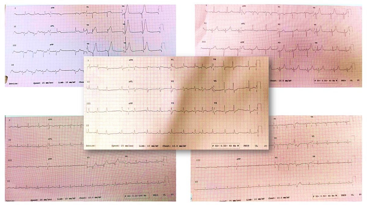 HatimLawati's tweet image. Post Call Reflections: reviewing #STEMIs from the last 24 H. Now there has to be a theme!! the one in the middle though!!!

#STEMI #CardioTwitter #CardioEd #ECG #acs #echofirst
