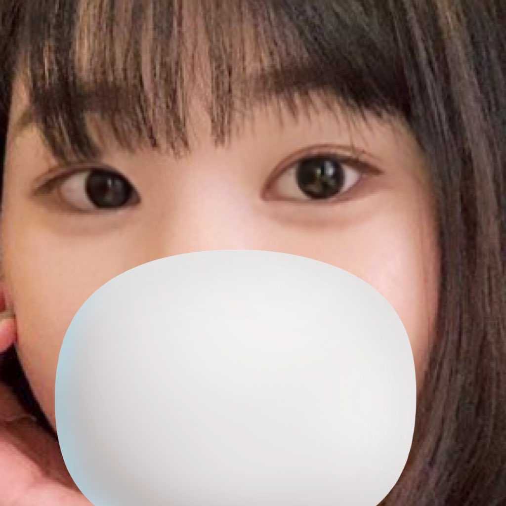 MFYou5's tweet photo. ZESTARさん(@zestarps)で目尻切開、目下切開を受けて2か月が経過しました🫧

一回目の目尻切開の時に術後1か月で後戻りしたことあるので、どうなるんだろう😣と少し不安だったけど、今回は後戻り感なくてすごい…😲と思ってます💘
奥二重でも白目が広くて目が大きく見えてとても満足してます！ https://t.co/lGUSVMsopa