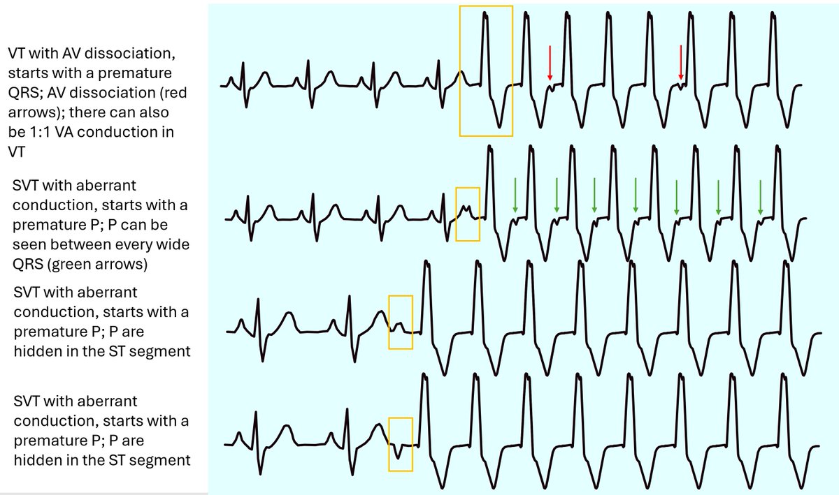 ecgandrhythmRoe's tweet photo. How can you distinguish a VT from an SVT with aberrant conduction; maybe a little help 👇 ?
(created with Affinity Designer) https://t.co/FglfloB9sS