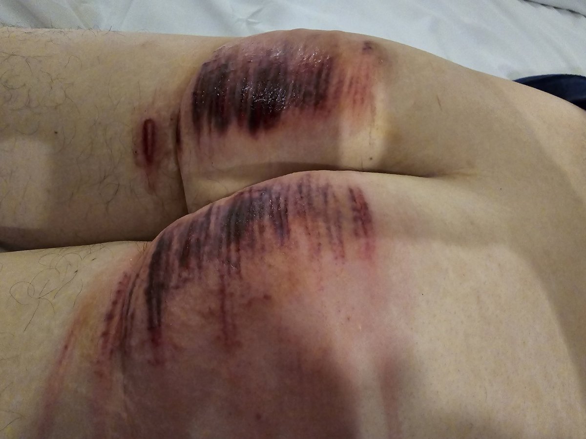 오늘자 플 기록. 처음 워밍업 20대 제외하고 모두 80cm가 넘어가는 케인으로만 했으며 160~180대 정도 한걸로 기억(맞나?). 양쪽 다 최대한 공평(?)하게 자국을 남겨보려고 노력했다🤭 #체벌 #스팽 #구인중 #멜투멜 #케인