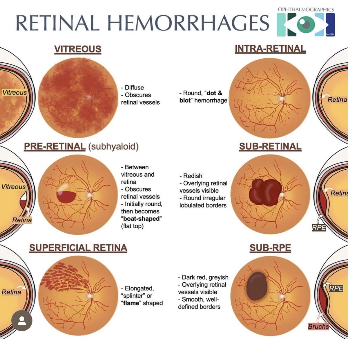 Retinal hemorrhages ophthalmographics