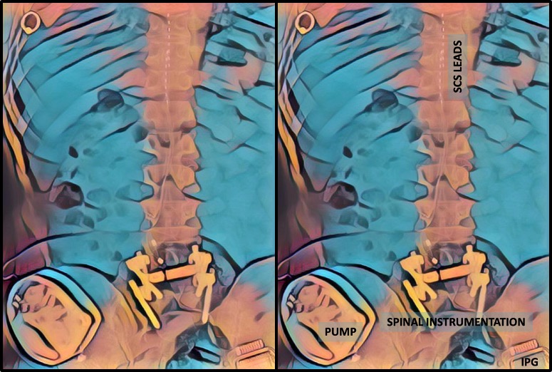 🔹Imagine #chronicpain as a symphony of discomfort, each note playing its own discordant tune. But just as a skilled composer orchestrates diverse notes into a harmonious melody,we can blend different #neuromodulation techniques – #SpinalCordStimulation, #intrathecal therapy,
1/n