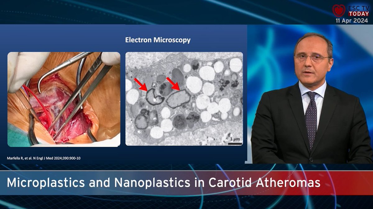 Micro- (<.5 mm) and nanoplastics (<.1 µm) are everywhere (water, food, air) - @EAPCIPresident E. Barbato reports on #ESCTVToday: 60% of excised carotid atheromas contain plastics, downstream event rate 4 times higher if present. watch: esc365.escardio.org/event/1148 (start at 5:30)