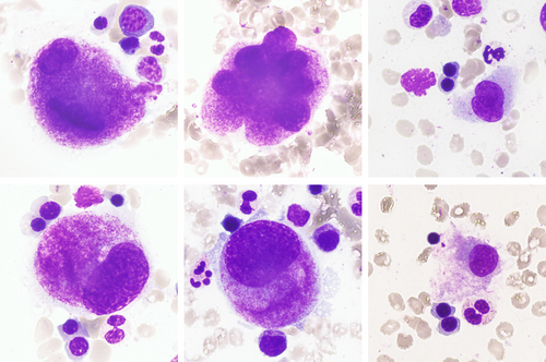 Megakaryocyte morphology with GATA2 germline mutation onlinelibrary.wiley.com/doi/10.1002/aj…