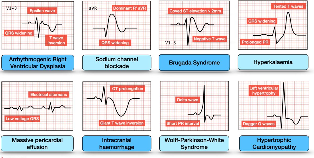 Don't Miss ECG Patterns.