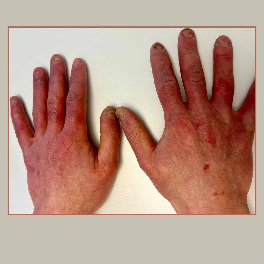 AngioUpdates's tweet photo. 55yo male pat w/severe #acrocyanosis since youth

• Deformity + dystrophy of fingernails, local skin defects 

• Iris diaphragm phenomenon, post  pressure application  

• Entirely healthy arterial status

• Abnormal capillary pattern in nailfold capillary microscopy 

=> https://t.co/zmV50ebEZJ
