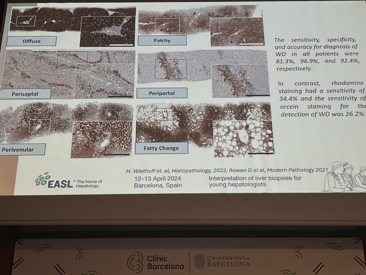 Good to see new knowledge published in @Histo_Journal presented at educational seminars: Metallotheionin immunostain is a better marker for #WilsonDisease than simple histochemical stains @ESP_Pathology @LiverPath_HPHS @EASLnews @UKLiverPath onlinelibrary.wiley.com/doi/full/10.11…