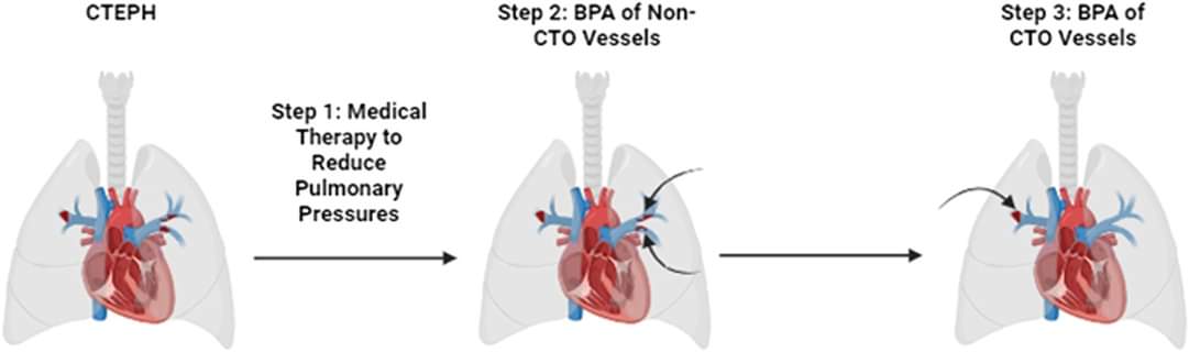 🔴 Complete Revascularization of the Pulmonary Circulation in Chronic Thromboembolic Pulmonary Hypertension: Value of Addressing Chronic Total Occlusions #openaccess #editorial 

onlinecjc.ca/article/S0828-…
#CardioEd #Cardiology #FOAMed #meded #MedEd #Cardiology #CardioTwitter
