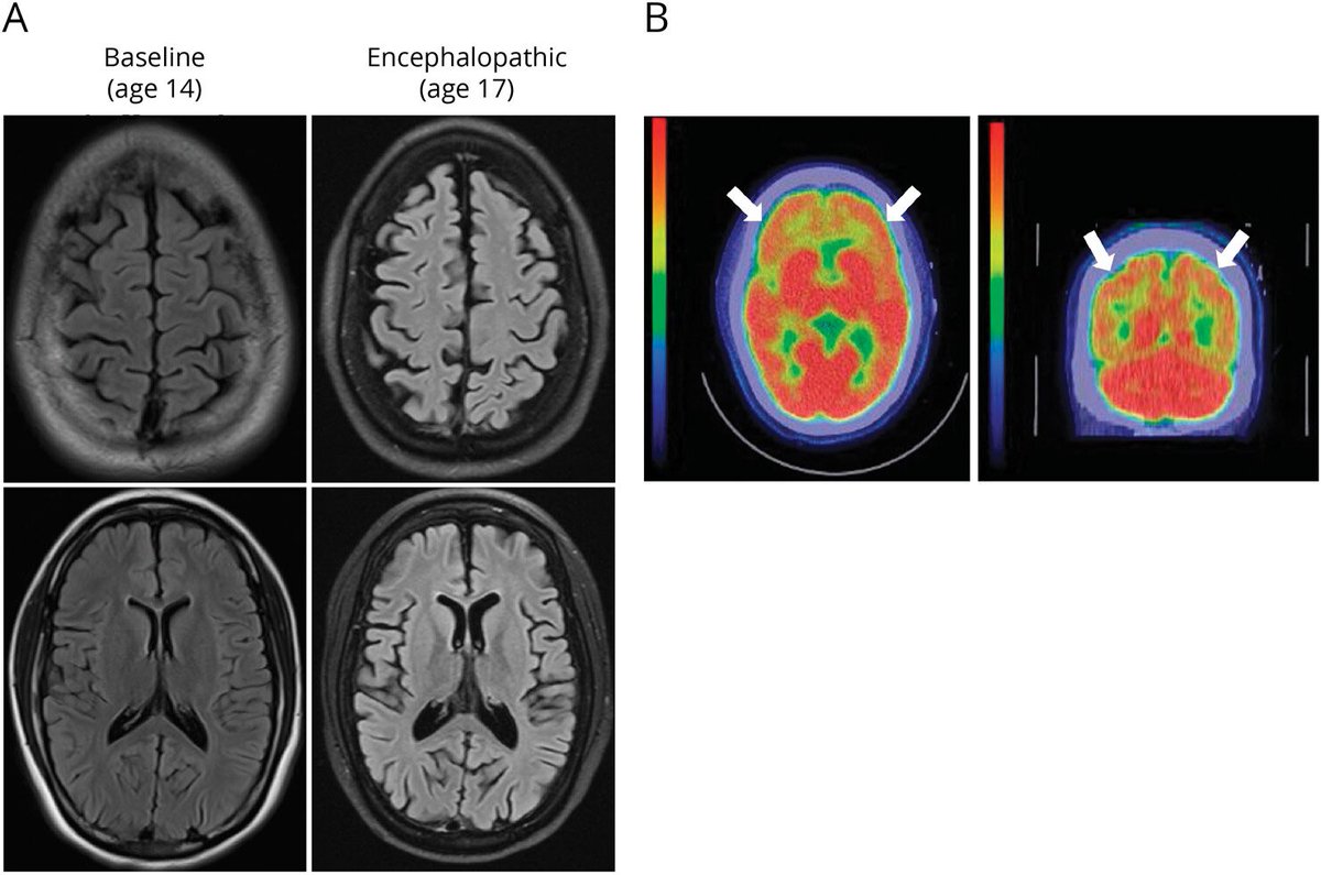 認知症精査でVitB12は測定すると思いますが

稀なtreatable dementia
Cobalamin-G deficiency 
VitB12が正常でもその利用障害を起こしているので、治療には補充が必要