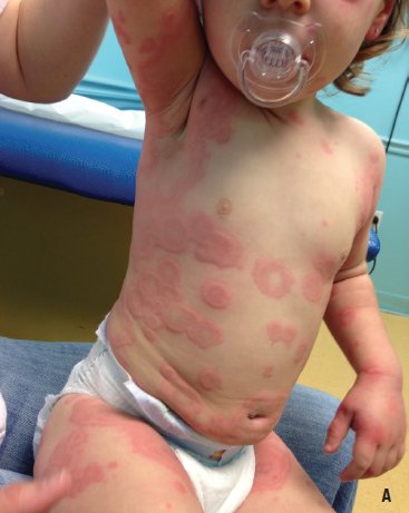 Gazal6849's tweet photo. 🟣𝘾𝙇𝙄𝙉𝙄𝘾𝘼𝙇 𝙎𝘾𝙀𝙉𝙀𝙍𝙄𝙊:-

📙A 2yr old girl p/w polycyclic, annular lesions with Ecchymotic centre accompanied by acute h/o low grade fever &amp; itching.

What is likely #diagnosis ❓❓

#medx
#medEd
@fxgodzeuss 
@IhabFathiSulima https://t.co/DZIOrDWQKl
