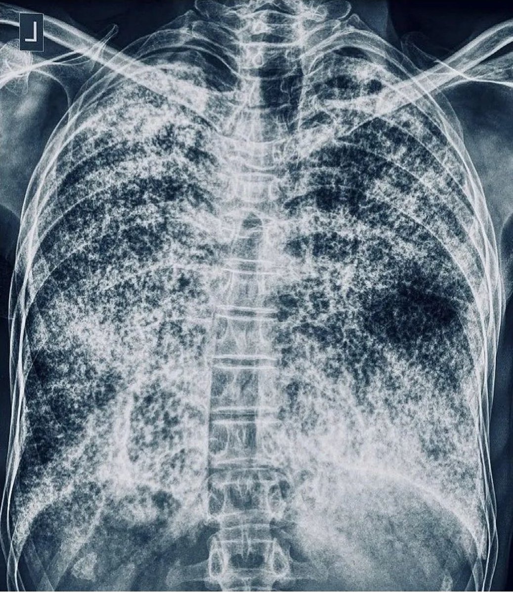 A patient with progressive dyspnea and dry cough for 3 months. Chest x-ray reveals the vanished heart. What is the diagnosis?
#MedTwitter #MedX #MedEd