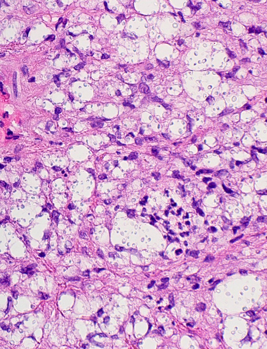 Multiple papules on trunk & extremities of adult. Diagnosis? 
More pics: kikoxp.com/posts/17926 
Answer: kikoxp.com/posts/17925
#pathology #pathologists #pathTwitter #dermpath #dermatology #dermatologia #dermtwitter