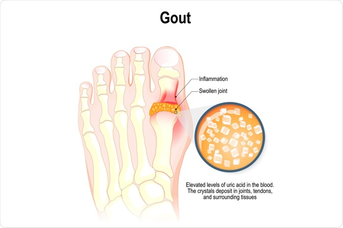 Which of the following is commonly used in the management of GOUT disease.?🩺 A) Nebivolol B) Allopurinol C) Metoprolol D) Atenolol