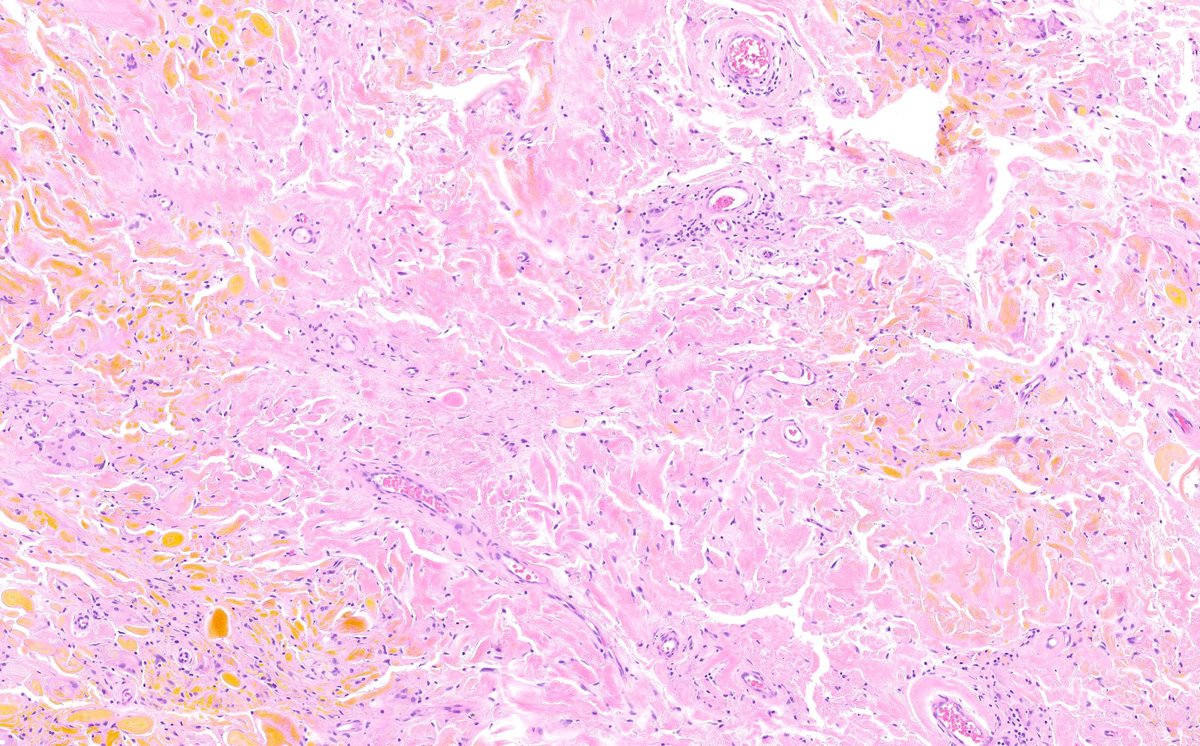 KyleDPerryMD's tweet photo. I know there is a subcutaneous mass, but where are all the cells? #BSTpath, #UMichPath,#BSTpathGoBlue, #dermpath