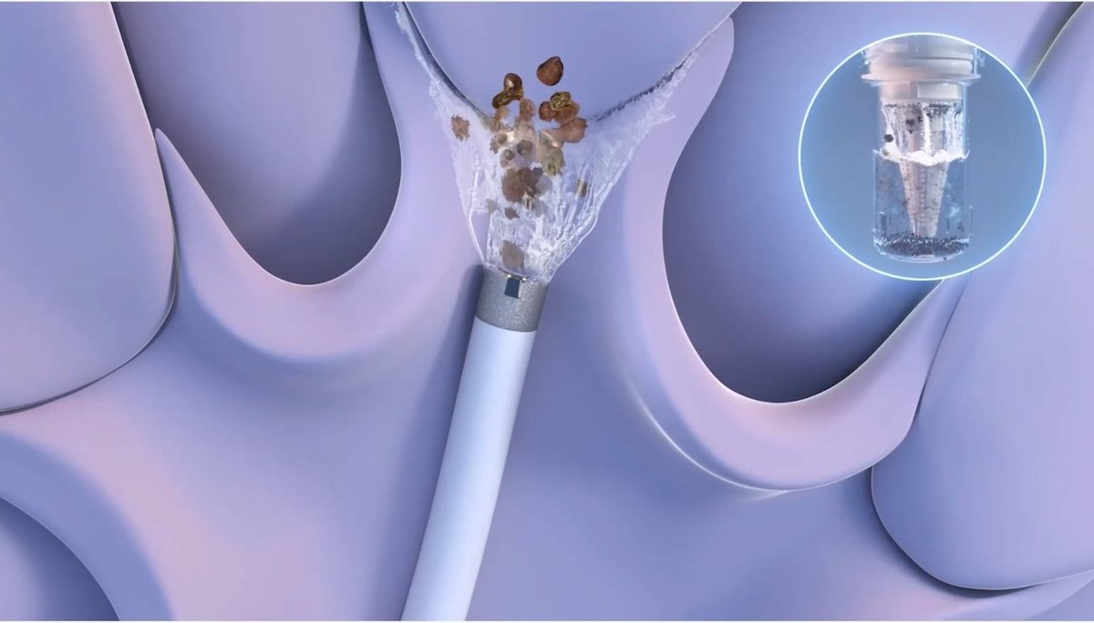 Thank you @CalyxoInc and @Endo_Society for the opportunity to demonstrate this remarkable device that might dramatically alter how we address larger renal calculi.