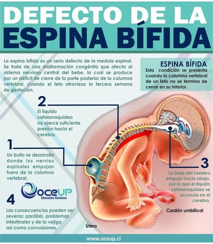 Ayuda a un joven Zuliano con condiciones especiales, displasia de La cadera, mielomeningocele, espina bífida, vejiga neurogénica, hidrocefalia (escaras varias, paciente encamado, tengo realizada una cistostomia hace 4 años) si deseas ayudarme PAGO MÓVIL BDV 12622918 04246663432🙏